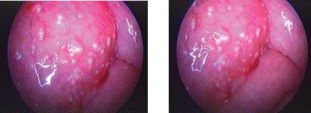 Deposits of schisto eggs at the ovary and fallopian tube (seen during laparoscopy, source) 