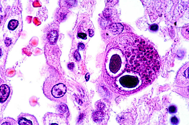 Cells infected with CMV have a characteristic "owl's eye" appearance seen above (source) 