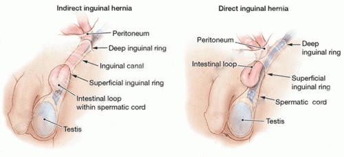 Comparison between direct and indirect inguinal hernias (source) 