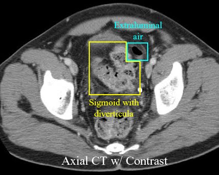 If imaging is needed, a CT scan can demonstrate diverticulitis. It can even show the presence of extraluminal air that is suggestive of perforation (source) 