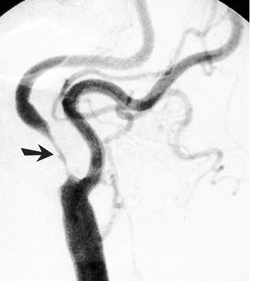 MR angiography showing carotid artery stenosis (source) 
