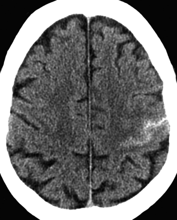 A non-contrast axial CT of the cranium demonstrates a left subarachnoid hemorrhage in the central sulcus (source) 