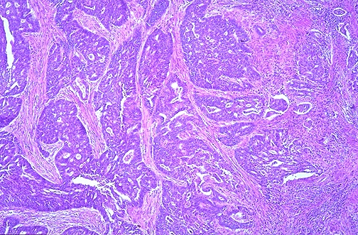 Histological analysis of this biopsy of endometrial cancer shows a characteristic glandular pattern that is typical of adenocarcinoma (source)