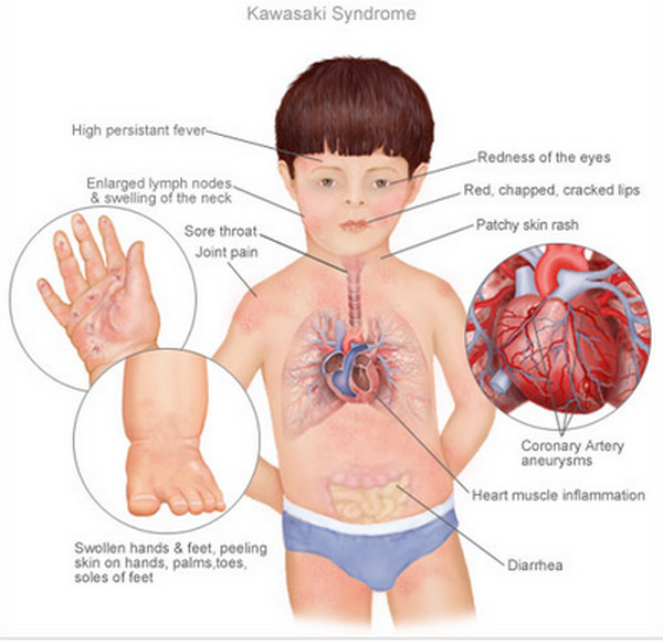 Clinical consequences of Kawasaki disease (source)