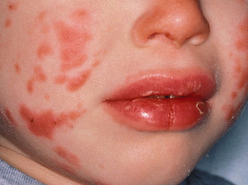 One example of the rash seen in Kawasaki syndrome (source) 