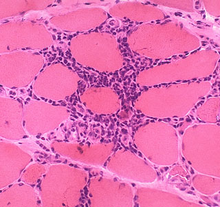 This biopsy of a patient with polymyositis shows immune cell infiltration (source) 