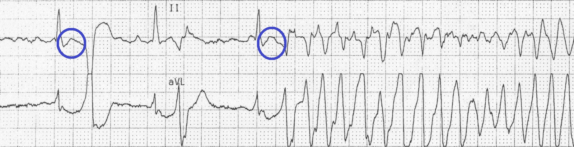 EKG showing R-ont-T phenomena that eventually transitions to torsades (source) 