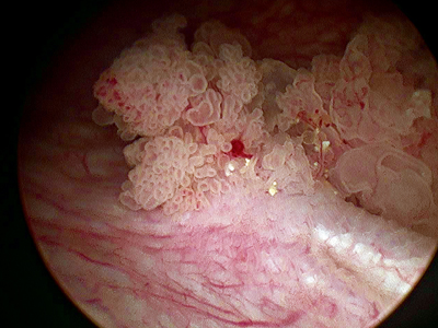 Visual appearance of a bladder cancer tumor on cystoscopy (source)