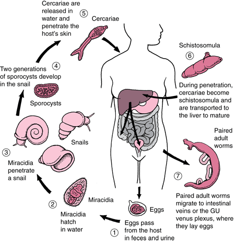 schistosomiasis usmle