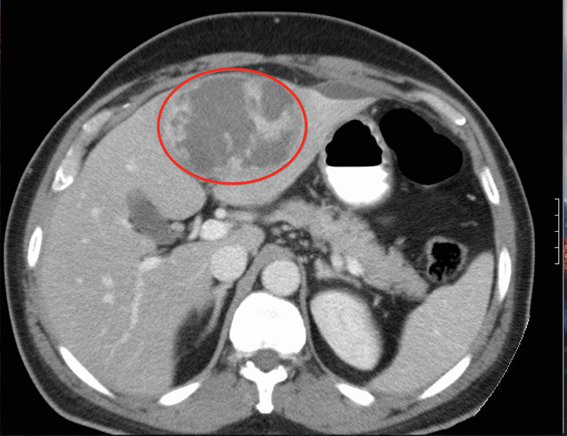 Hepatic abscess seen on a CT scan in a patient with amebiasis (source)