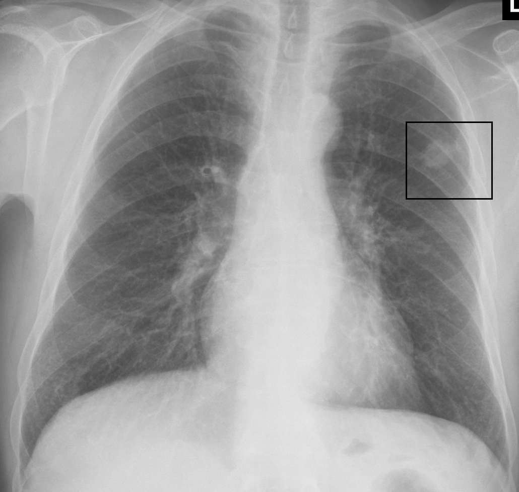 Chest X-ray in a patient with Lambert-Eaton showing a lung malignancy that is likely the underlying cause of the disease pathology (source)