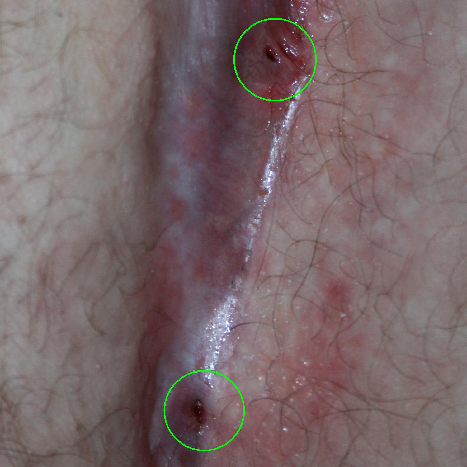 Visual appearance of 2 pilonidal cysts on a patient (source)
