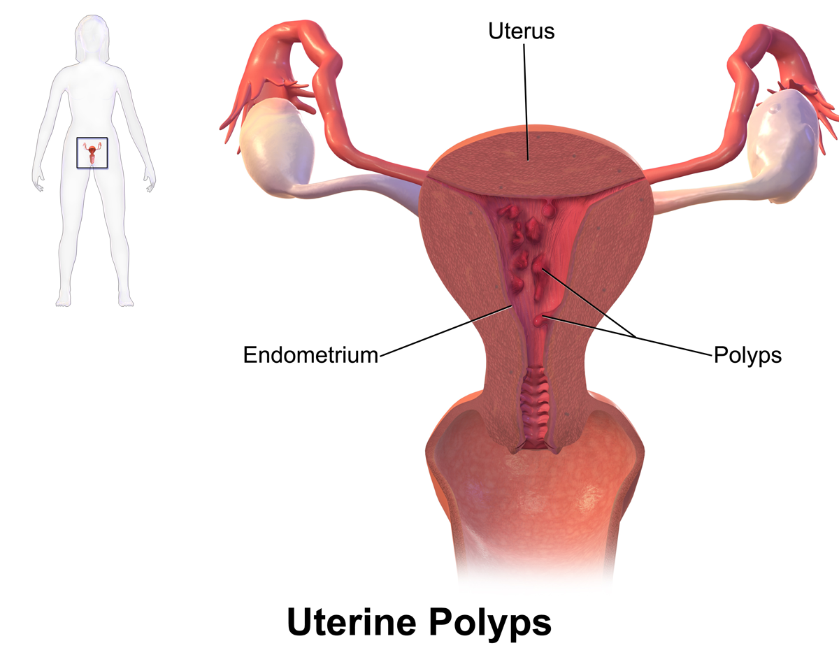 Uterine polyps can be a beginning cause of PMB in patients (source)