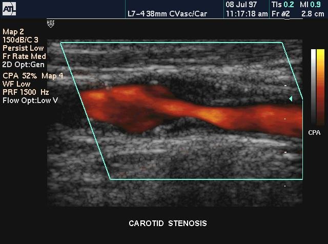 Doppler ultrasound showing carotid stenosis (source) 