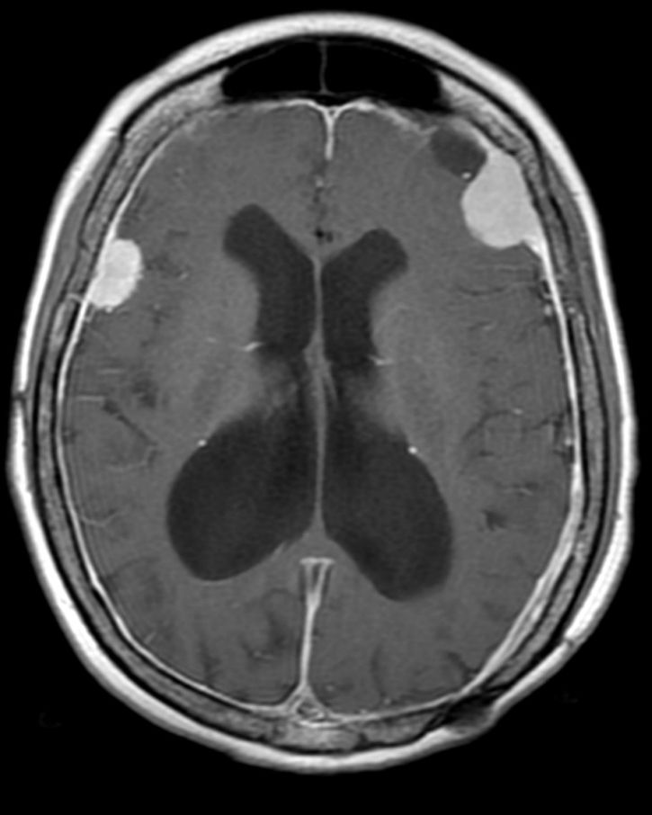 Two meningiomas can be seen clearly on the MRI above (source) 