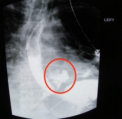 A contrast swallow study shows a lower esophageal rupture that leaks the ingested contrast agent (source) 