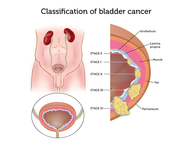 Stages of bladder cancer are dictated by which layers of the bladder are involved in the spread of the malignancy (source)