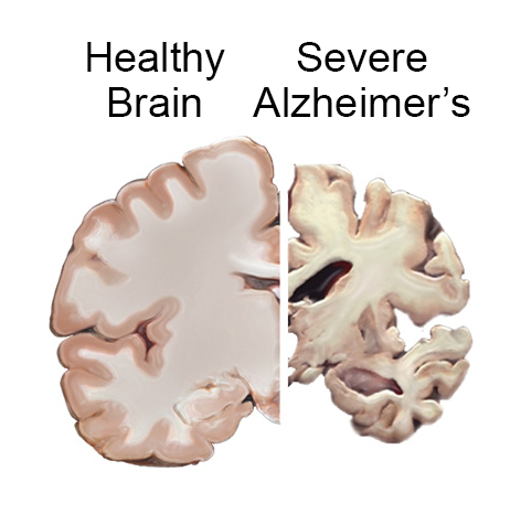 Alzheimer disease is a serious neurodegenerative disorder (source)