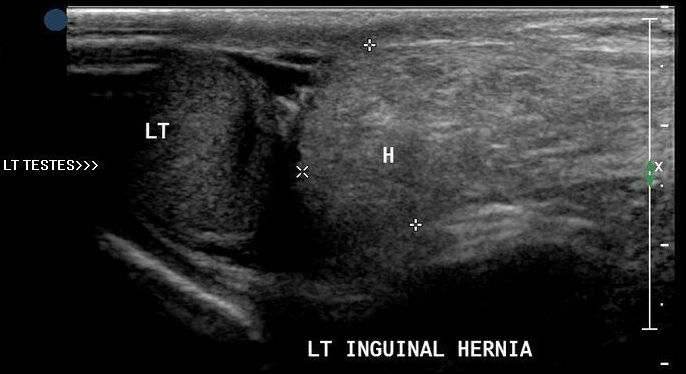 Testicular ultrasound showing a hernia (likely bowel) next to the left testicle (source) 