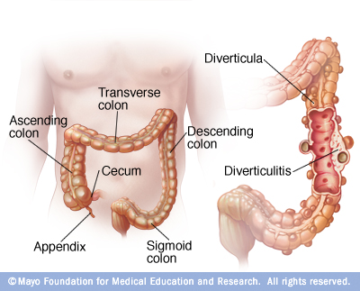 Diverticulitis refers to the inflammation of diverticula that are pre-existing (source). 