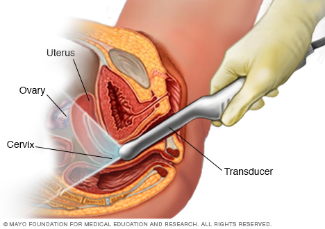 Transvaginal ultrasound technique (source) 