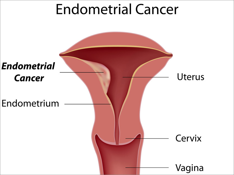 Patients with PMB should be evaluated for endometrial cancer as this can cause uterine bleeding (source) 