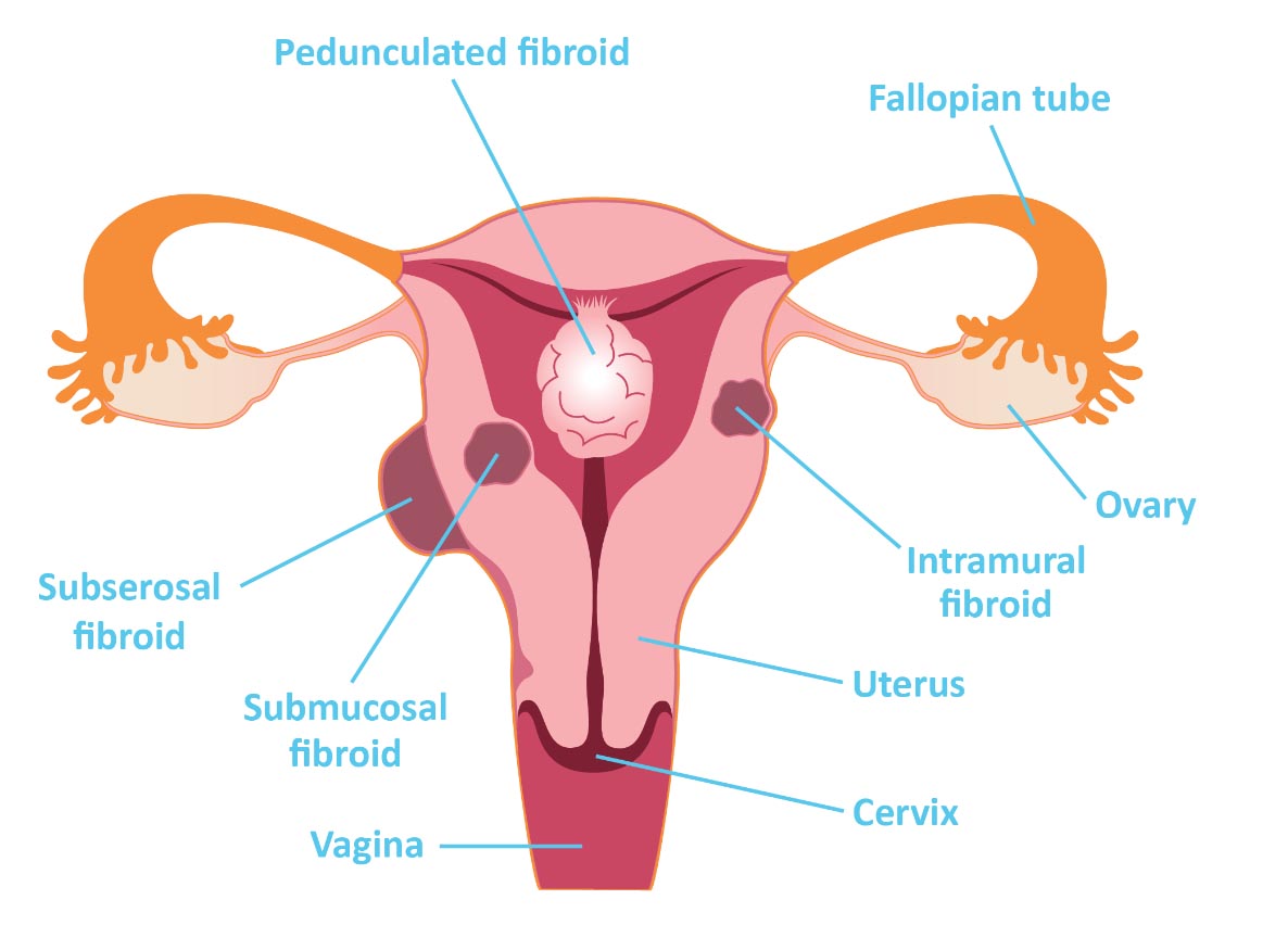 Different types of fibroids may sometimes (albeit less commonly) be the cause of PMB (source)