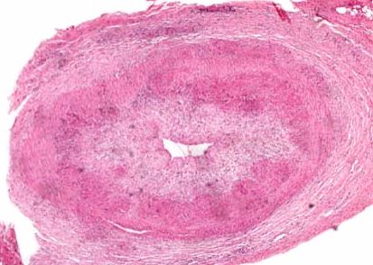 Artery biopsy of a patient with GCA shows inflammation to the point that the lumen of the artery has become compromised (source) 