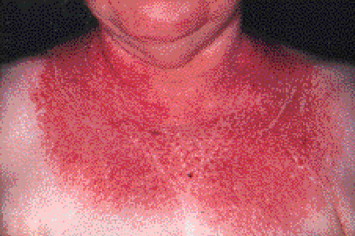 Shawl rash seen in a patient with dermatomyositis (source)