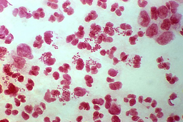 Gram stain of penile exudate showing gram negative diplococci suggestive of gonococcal urethritis (source) 