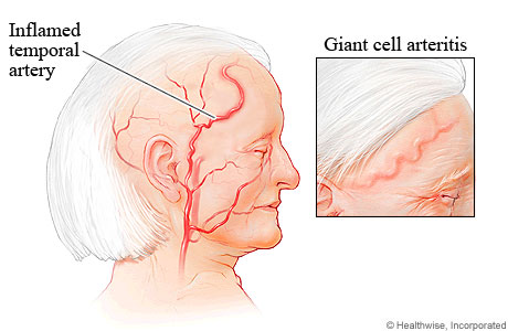 GCA often involves the temporal artery (source) 