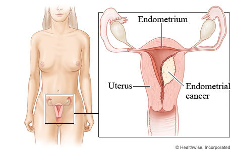 Endometrial cancer schematic (source) 