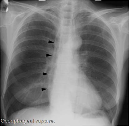 This X-ray of a patient with esophageal rupture shows signs of mediastinal free air (source) 
