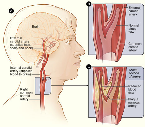 Carotid artery stenosis will impair the flow of blood through the affected arteries (source) 