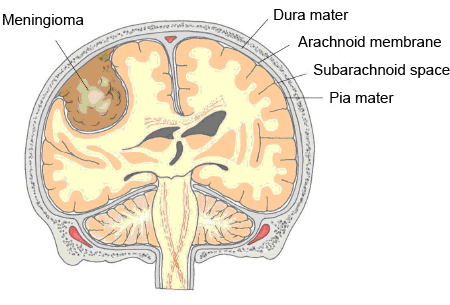 A meningioma arises from the meningeal layers OUTSIDE of the brain parenchyma (source)