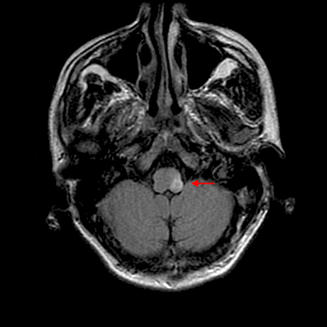 The MRI angiography study above shows the casual lesion in a patient with Wallenberg syndrome (source) 