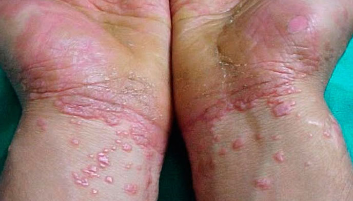 Visual appearance of lichen planus papules (source) 