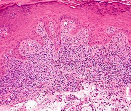 The above biopsy of a lichen planus papule shows the characteristic "sawtooth" pattern observed between the dermal and epidermal layers (source) 
