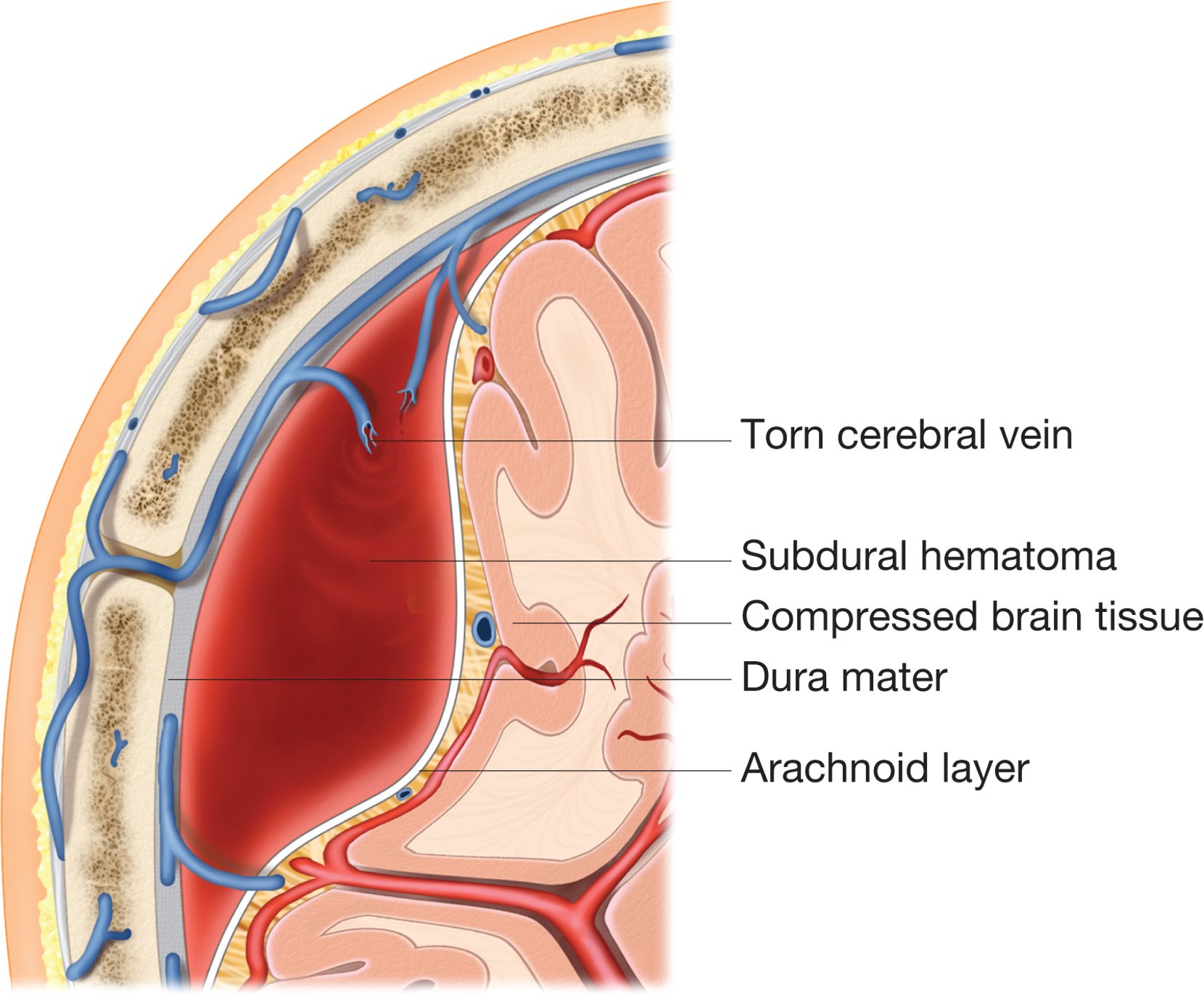 Anatomical location of a subdural hematoma. Not the bridging vein that is torn leading to the venous bleeding in subdural space (source)