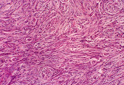 Common whorled histological pattern seen in meningioma (source)