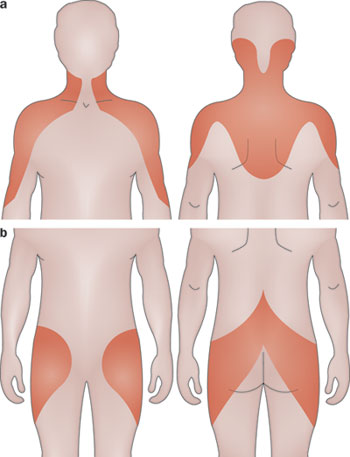 PMR often affects the neck and hips. It is characterized by stiffness and pain, but NOT weakness (source) 