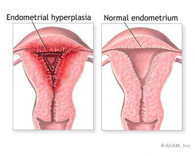 Endometrial hyperplasia can sometimes be the cause of vaginal bleeding post menopause. In the absence of exogenous estrogens, an endogenous source of estrogen production is important to identify (source)