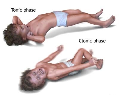 Phases of a tonic-clonic seizure (source) 