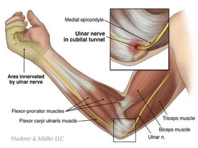 Anatomical pathway of the ulnar nerve after exiting the brachial plexus (source) 
