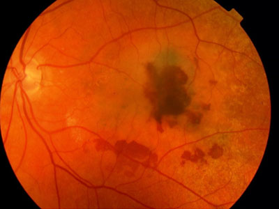 Visual appearance of large macular hemorrhages on fundoscopy in a patient with wet macular degeneration (source) 