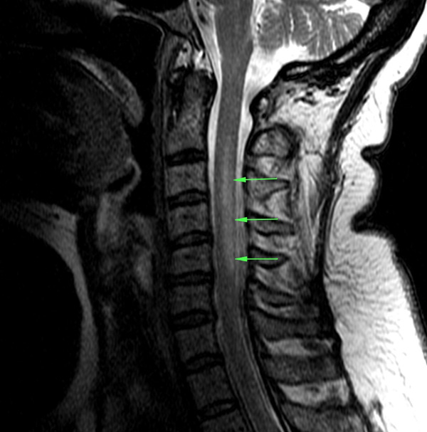 This patient with subacute combined degeneration has increased T2 signal in the posterior part of the spine (source) 