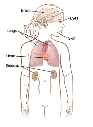 Different sites of tumor formation in tuberous sclerosis (source) 