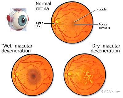 Comparison between wet and dry forms of macular degeneration (source) 