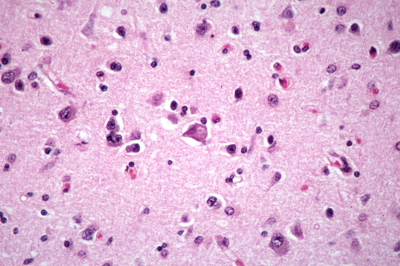 The autoposy of patients with Pick disease will show the presence of Pick bodies in cortical tissues (source) 