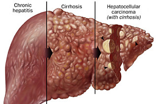 In some cases HBV infection can lead to liver cirrhosis and eventually. hepatocellular carcinoma (source) 